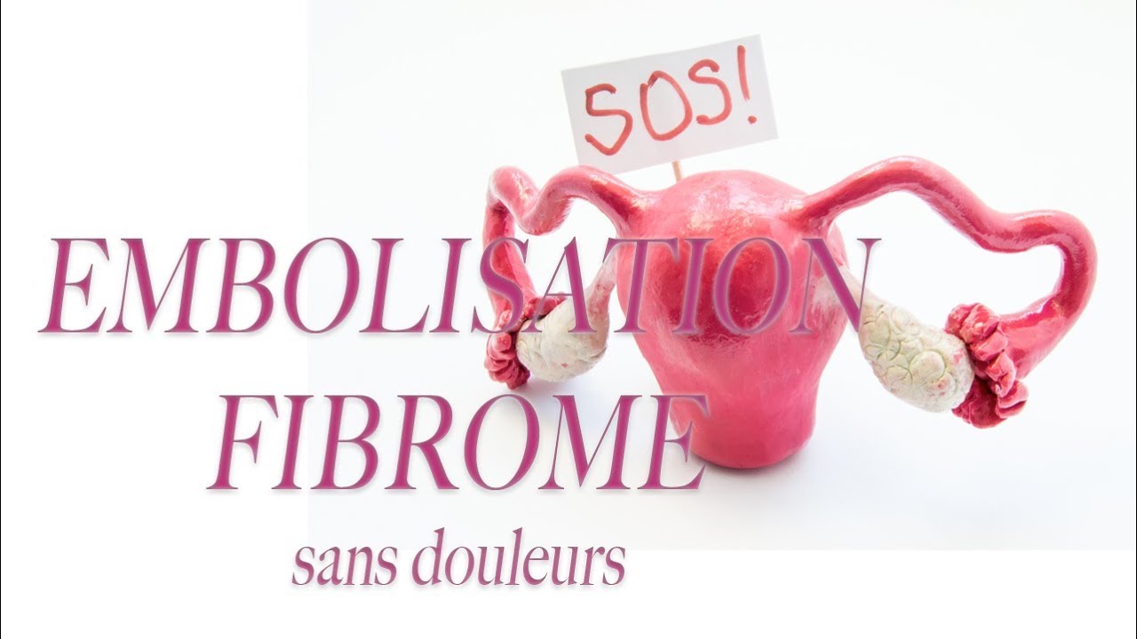 Traitement des Fibromes Utérins Sans Chirurgie grâce à l'EFU Sans Douleur