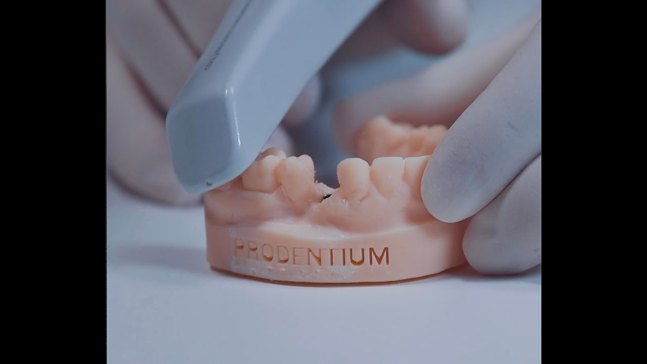 Come prendere un’impronta digitale su impianti con Scanner intraorale?