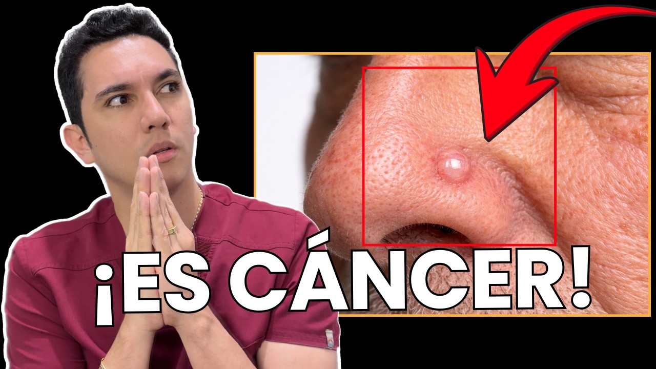 El cáncer más frecuente en el mundo (carcinoma basocelular) | Dr. William Guerrero