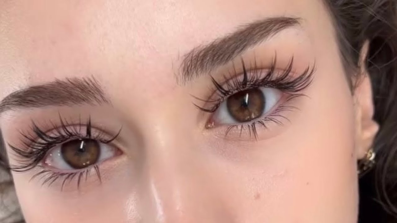 dark circles + sunken eyes removal💉