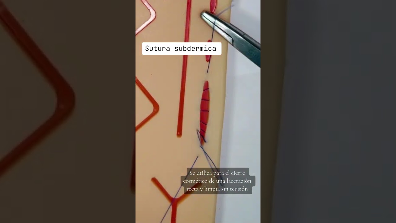 Sutura subdermica #suturas