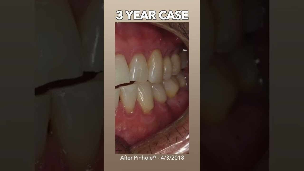You can scrub your gums away... (Chao Pinhole&reg; Surgical Technique)