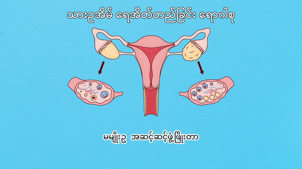 သားဥအိမ်ရေအိတ်တည်ခြင်းရောဂါစု (PCOS)