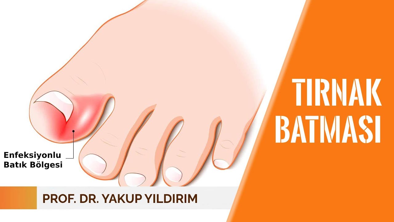 Tırnak batması neden olur? Nasıl tedavi edilir? | Prof. Dr. Yakup YILDIRIM