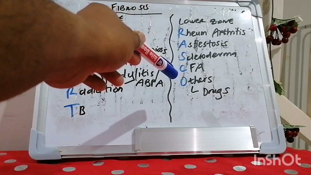 Mnemonic 37 : Upper vs lower zone fibrosis