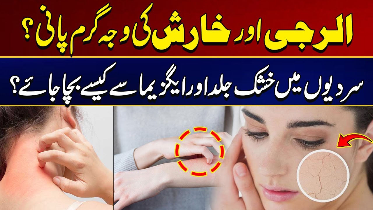 How to Avoid Dry Skin And Eczema in Winter? Must Watch | City 21
