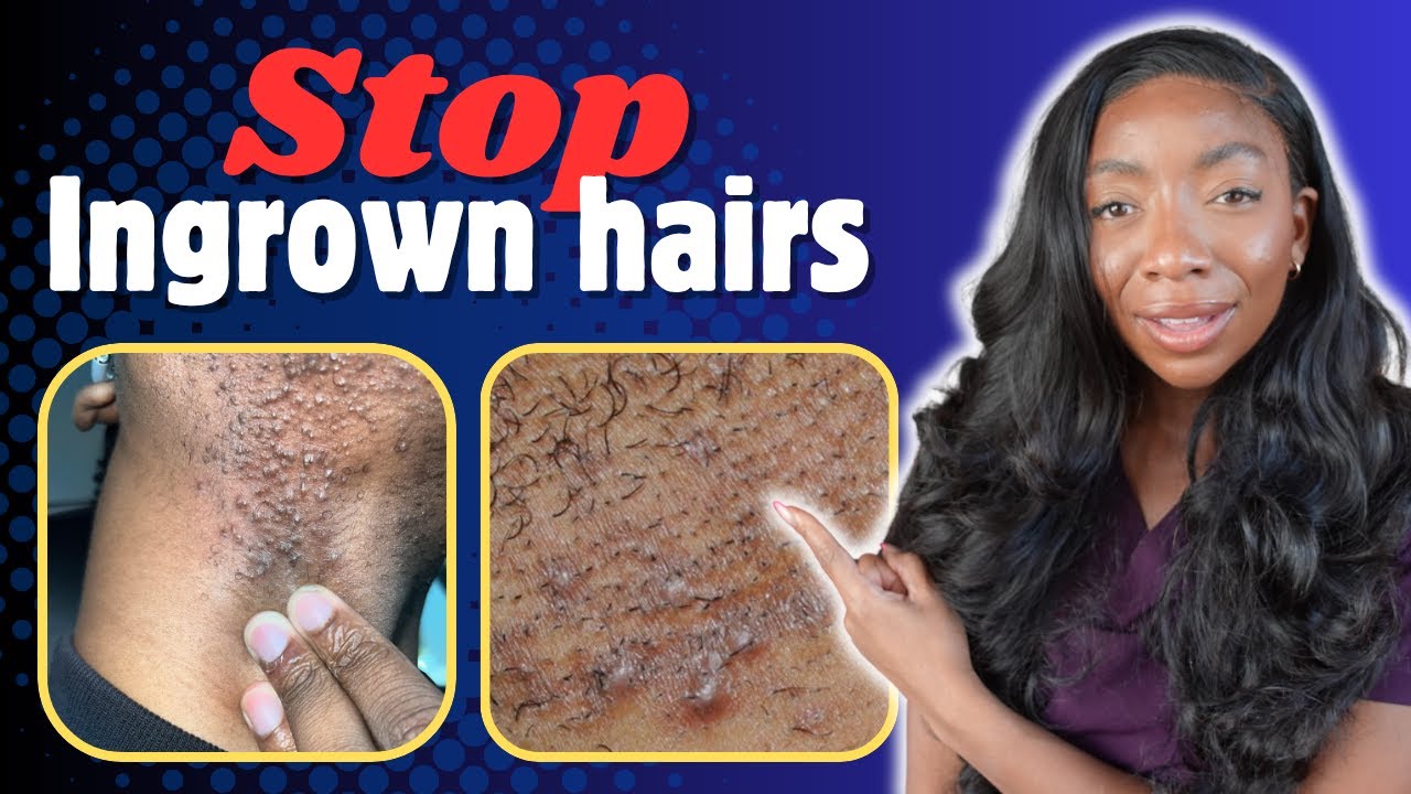 Doctor's Secret to Never Getting an Ingrown Hair Again