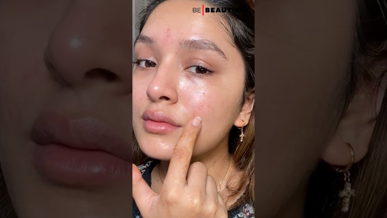 How To Get Rid Of Acne On Cheeks | Causes And Treatment For Acne | Be Beautiful #Shorts