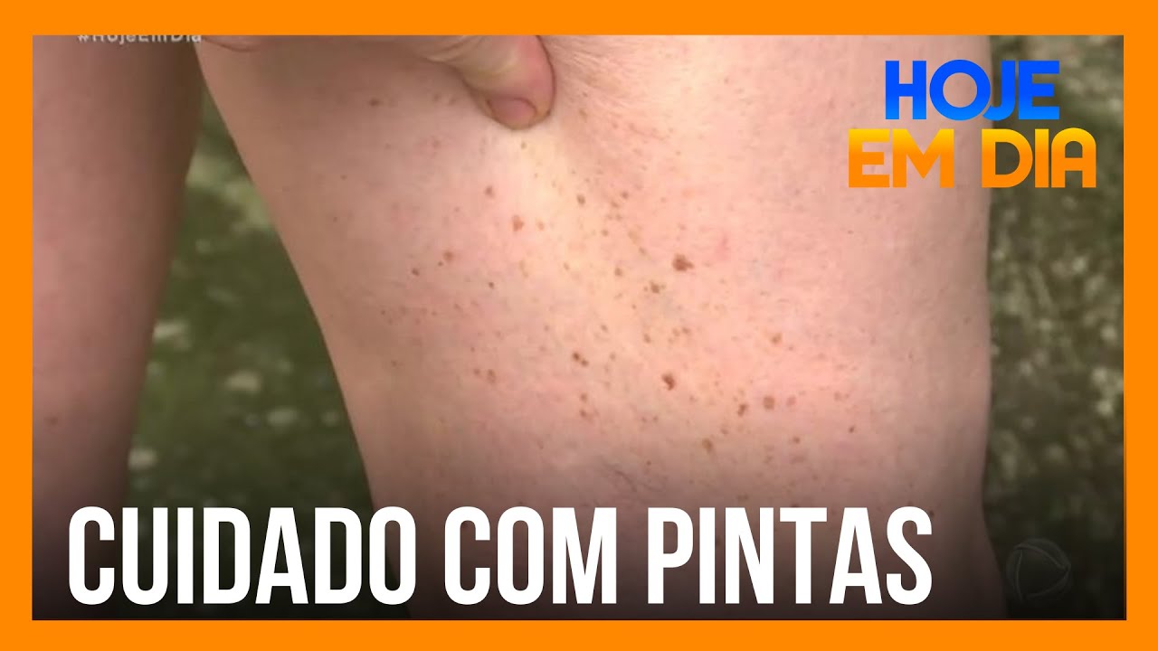 Cuidado! Pintas podem dar origem ao câncer de pele