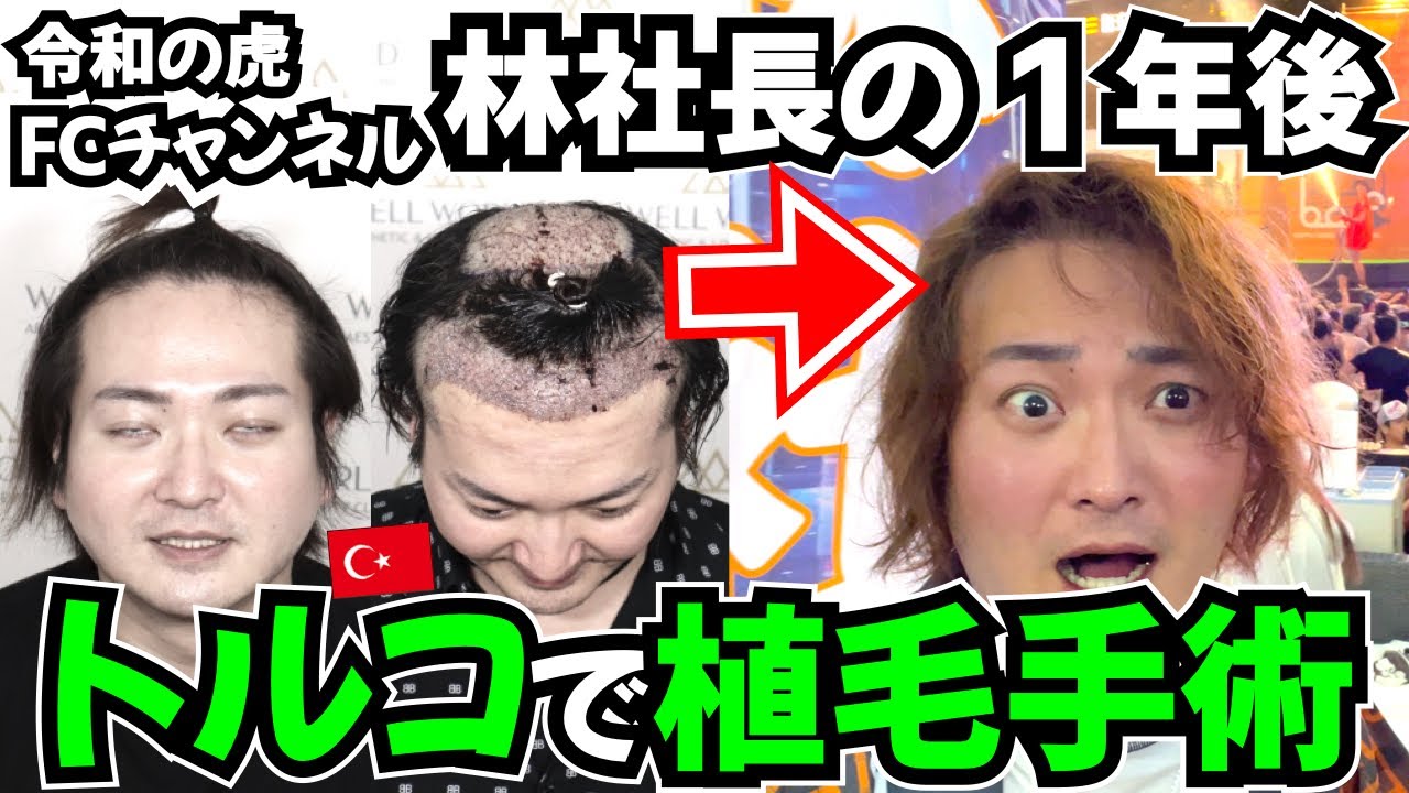 【お宝映像】令和の虎 林社長トルコ植毛の1年後に密着【自毛植毛｜フランチャイズチャンネル】