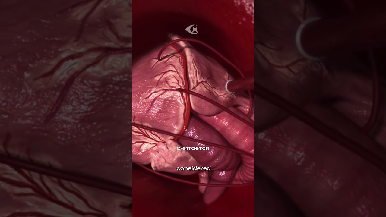 Как проводят коронарное шунтирование?