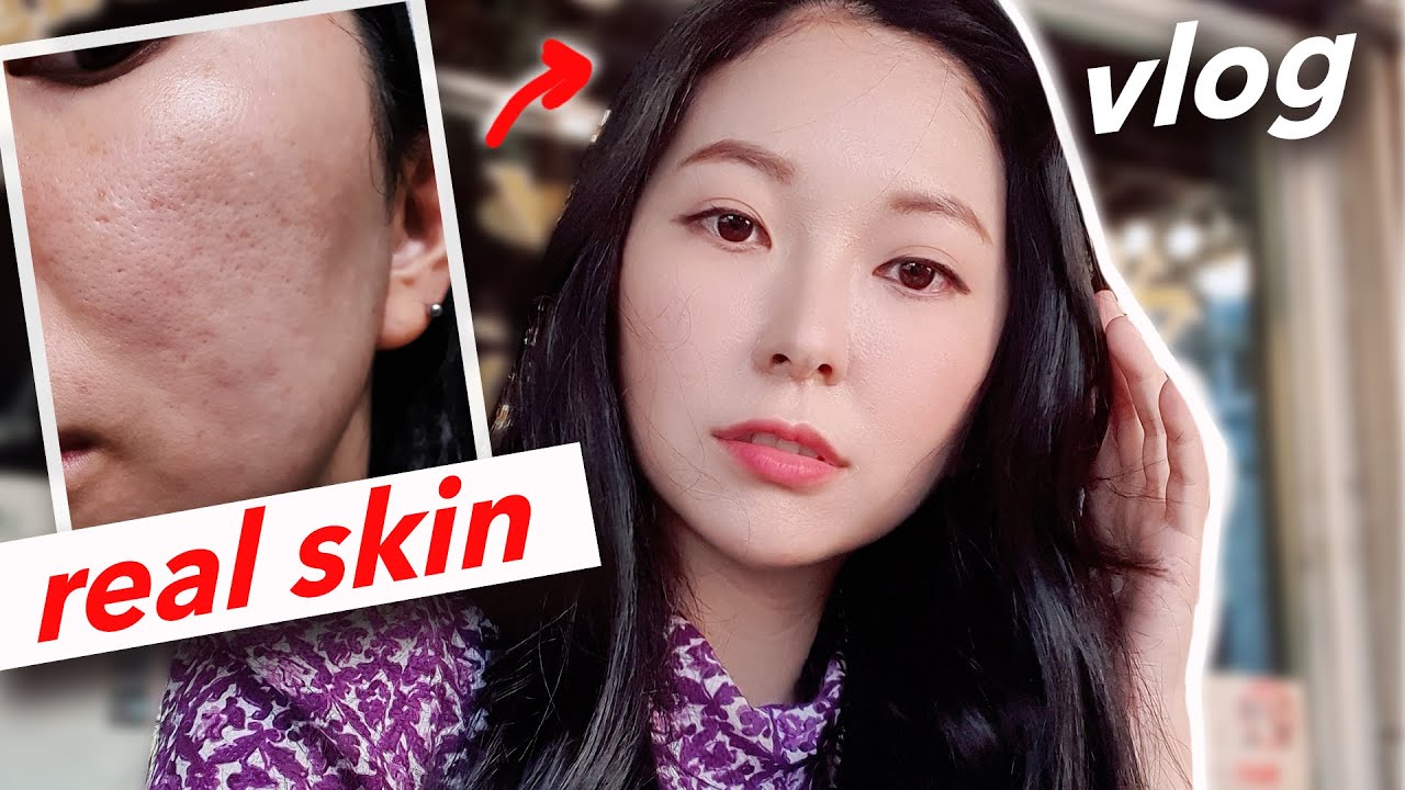 Revealing My Horrible Acne Scars! (visited top Korean skin care clinic)