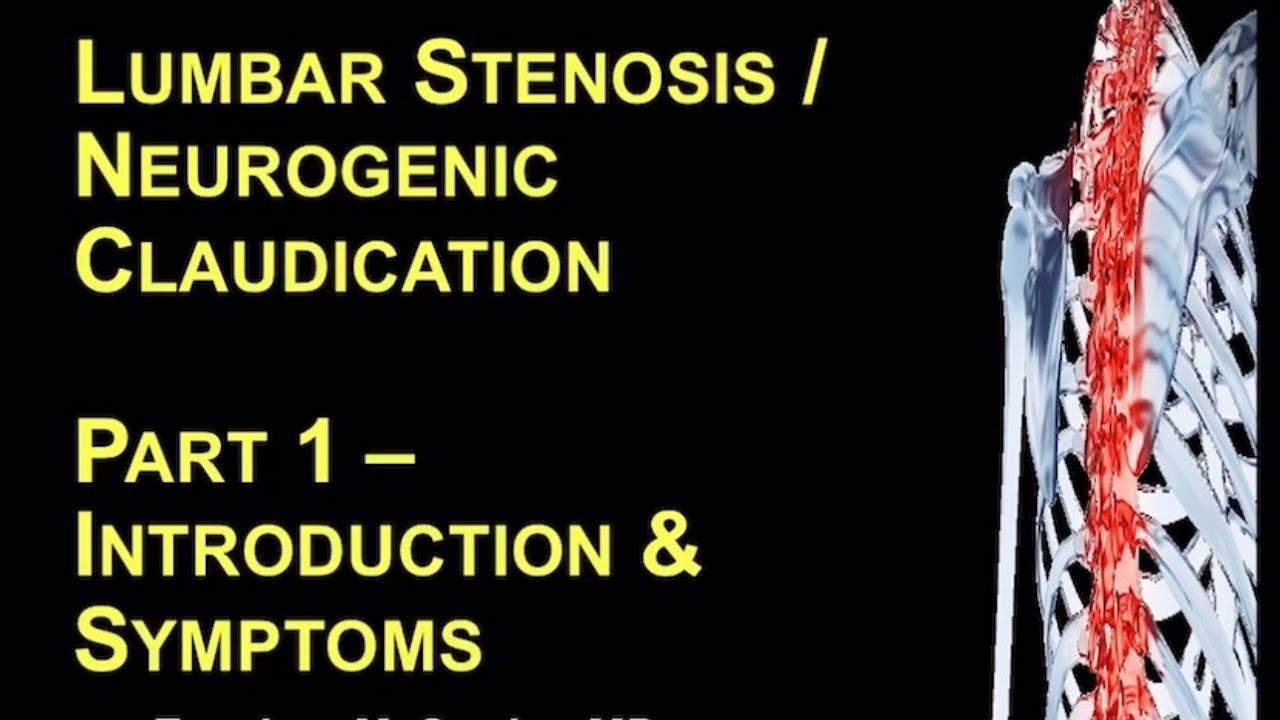 Lumbar Stenosis / Neurogenic Claudication. Part 1 &ndash; Introduction - Zeeshan Sardar, Spine Surgeon