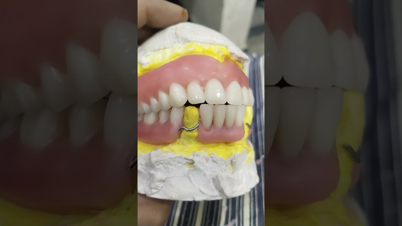 Soft Lining Upper Complete Lower Removable Partial Denture Ready for Flasking 😁😁😁