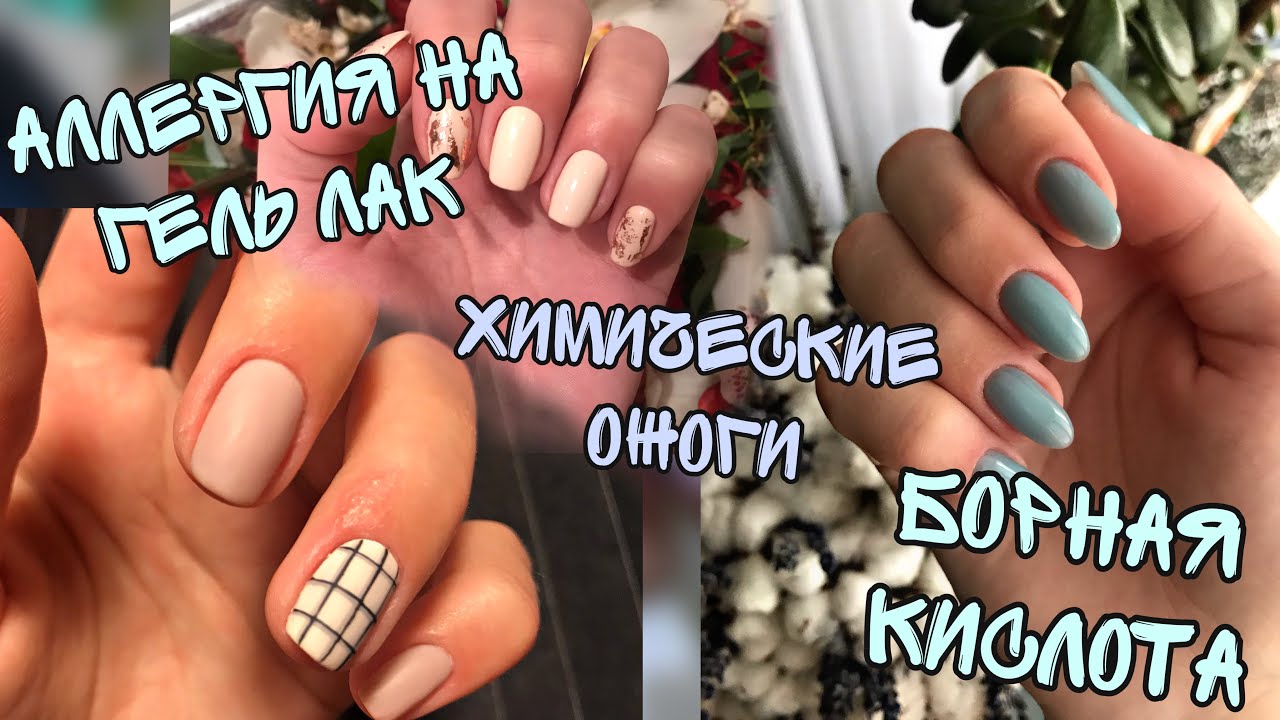 Аллергия на гель лак| Химические ожоги от гель лака| Зуд и прыщики после маникюра| Борная кислота