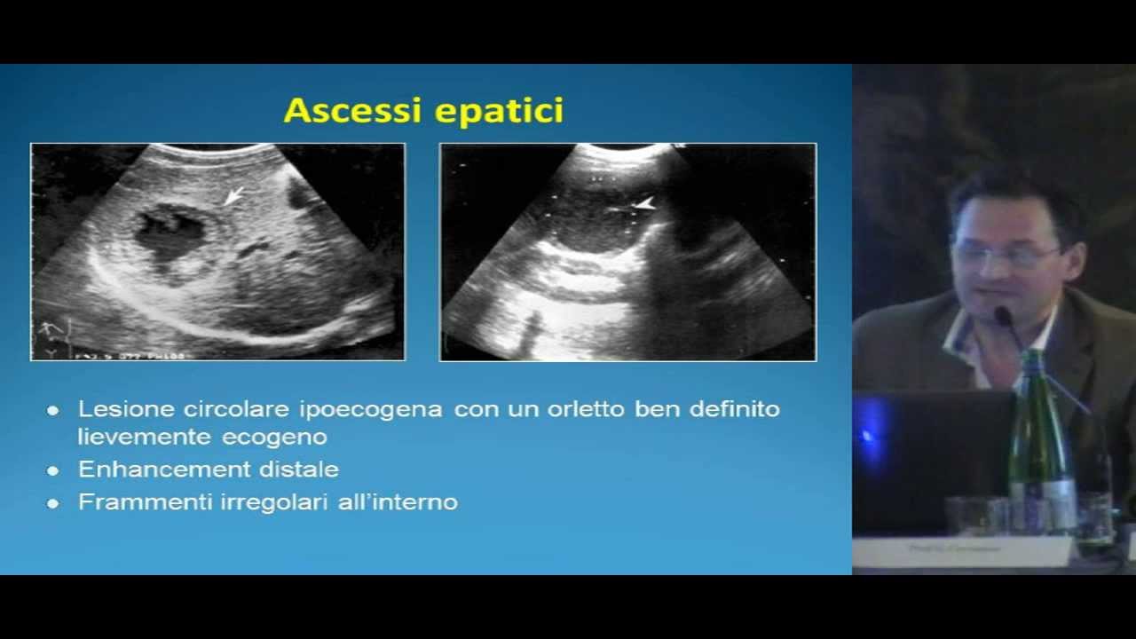 Lesioni Benigne del fegato  aspetti ecografici e Color doppler  G Cuccorese