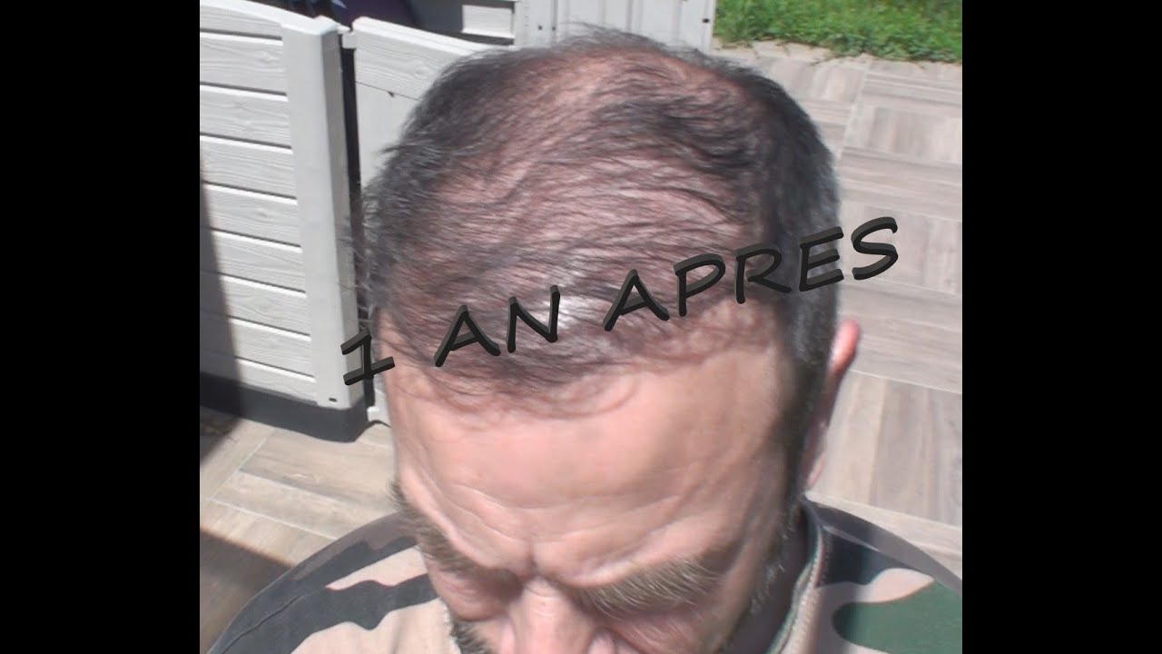 Greffe de cheveux methode DHI 1 an après