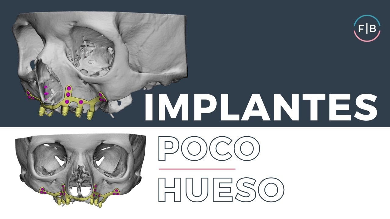 Implantes con poco hueso, la alternativa a implantes tradicionales en la Clínica Ferrus & Bratos