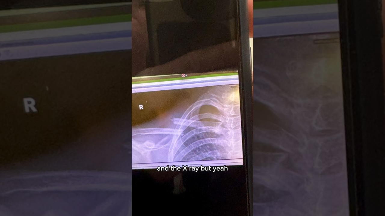 I broke my collarbone 😢