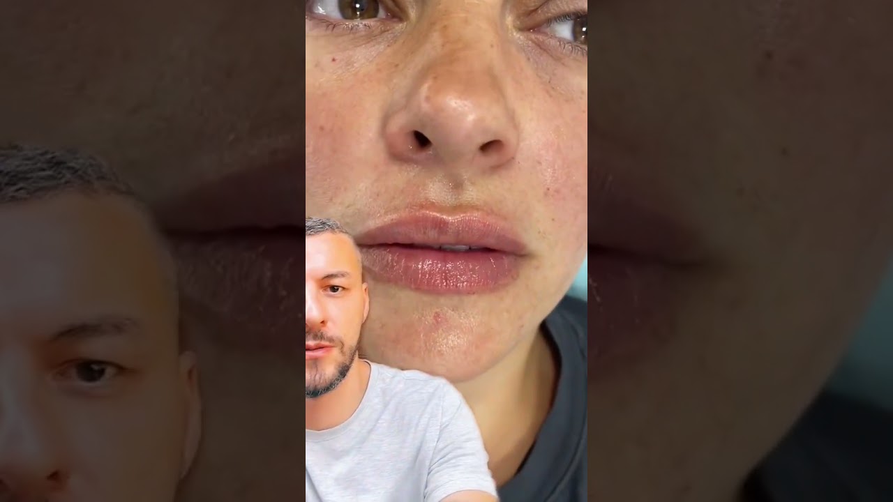 Korekcija usana hijaluronom