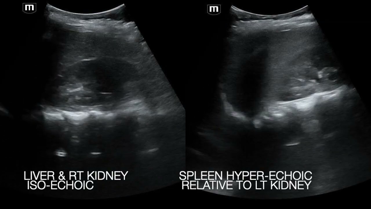 Acute Splenic Sequestration in 9 y.o. Girl Sickle Cell SC Disease