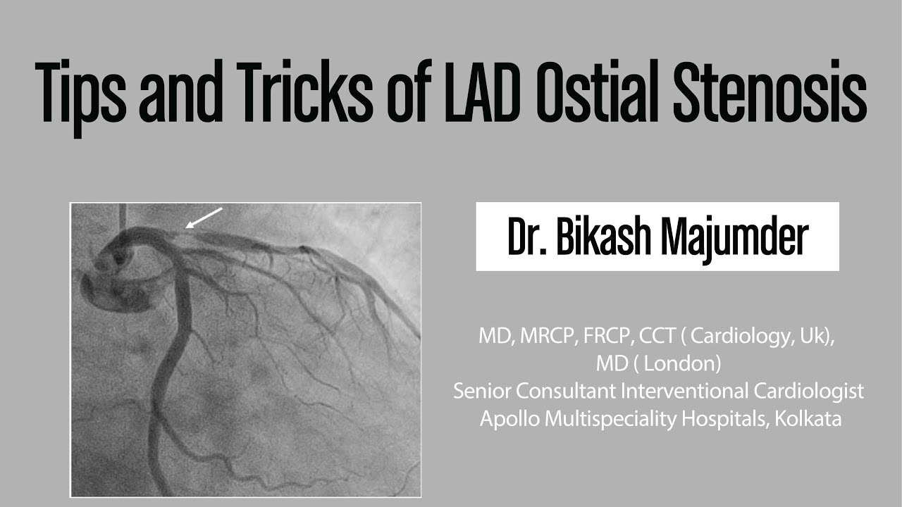 Советы и рекомендации по стенозу устья ПМЖВ