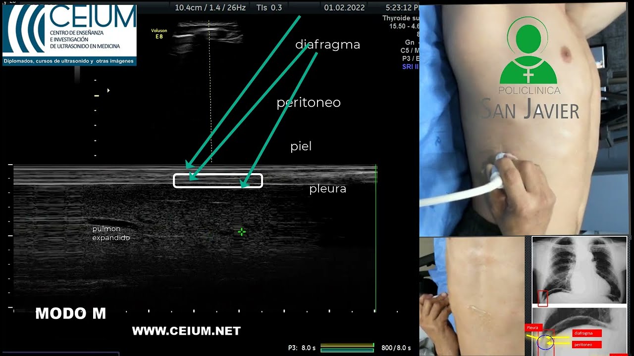 TUTORIAL ECOGRAFIA DEL  DIAFRAGMA MEDICION