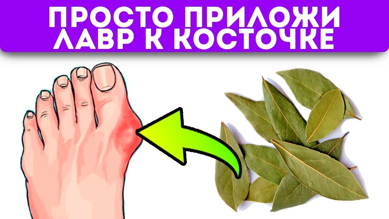 Косточка на ноге исчезла без операции! Запишите этот простой рецепт