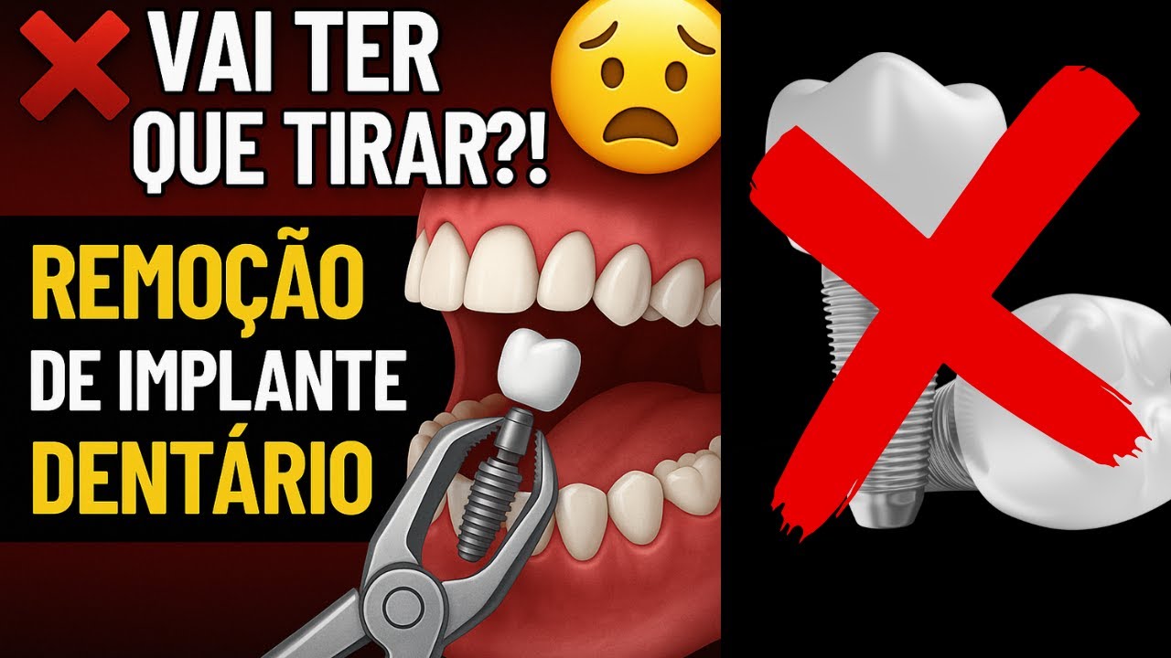 Como TIRAR FORA  meus IMPLANTES DENT&Aacute;RIOS