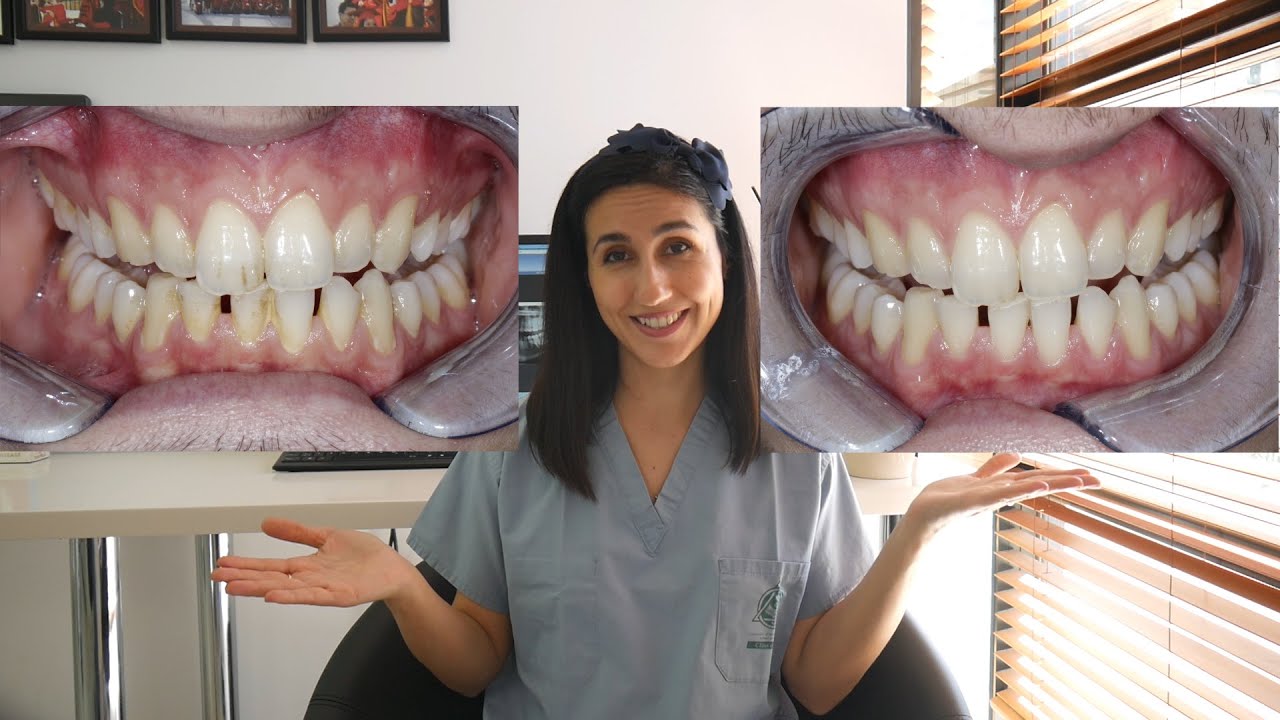 Professional Dental Cleaning Procedure