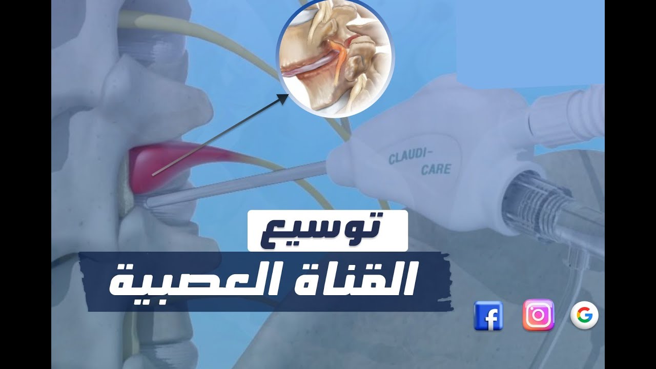 عملية توسيع القناة العصبية 