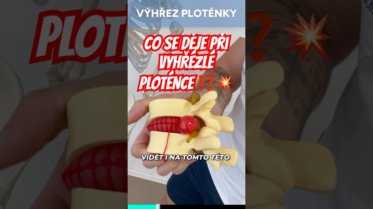 💥 Co se děje při v&yacute;hřezu plot&eacute;nky? 💿Bolest zad, kter&aacute; vystřeluje až do nohy? 🦵#vyhrezlaplotenka