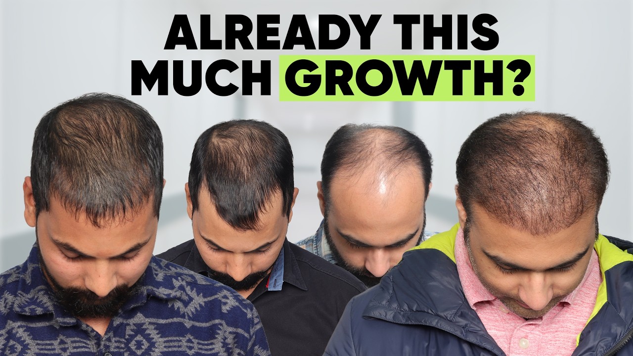 Hair Transplant in Indore (HX-TFED) | Best Results & Cost of Hair Transplant in Indore