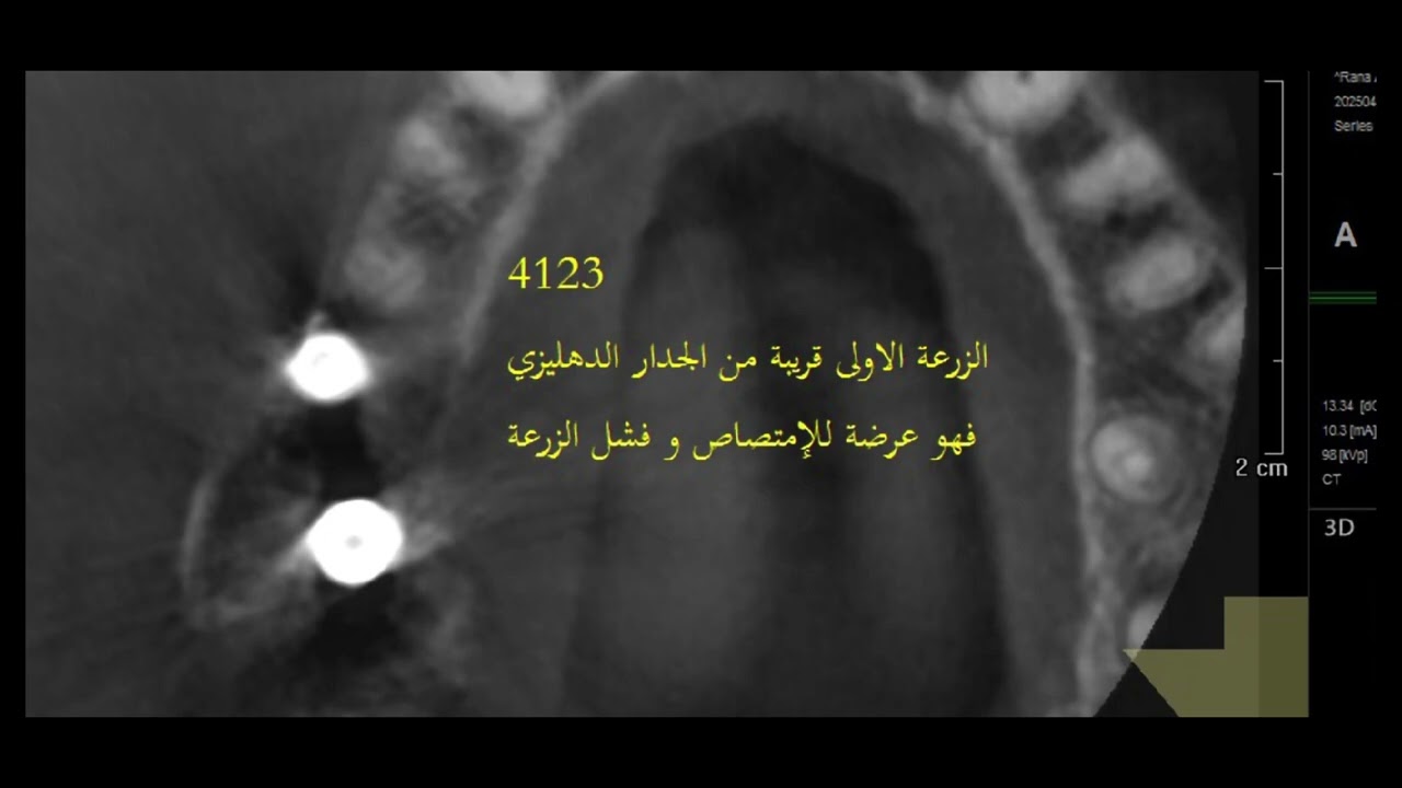 @أهمية الصورة ثلاثية الأبعاد بعد الزرع مباشرة في تحويل الحالة من الفشل إلى النجاح