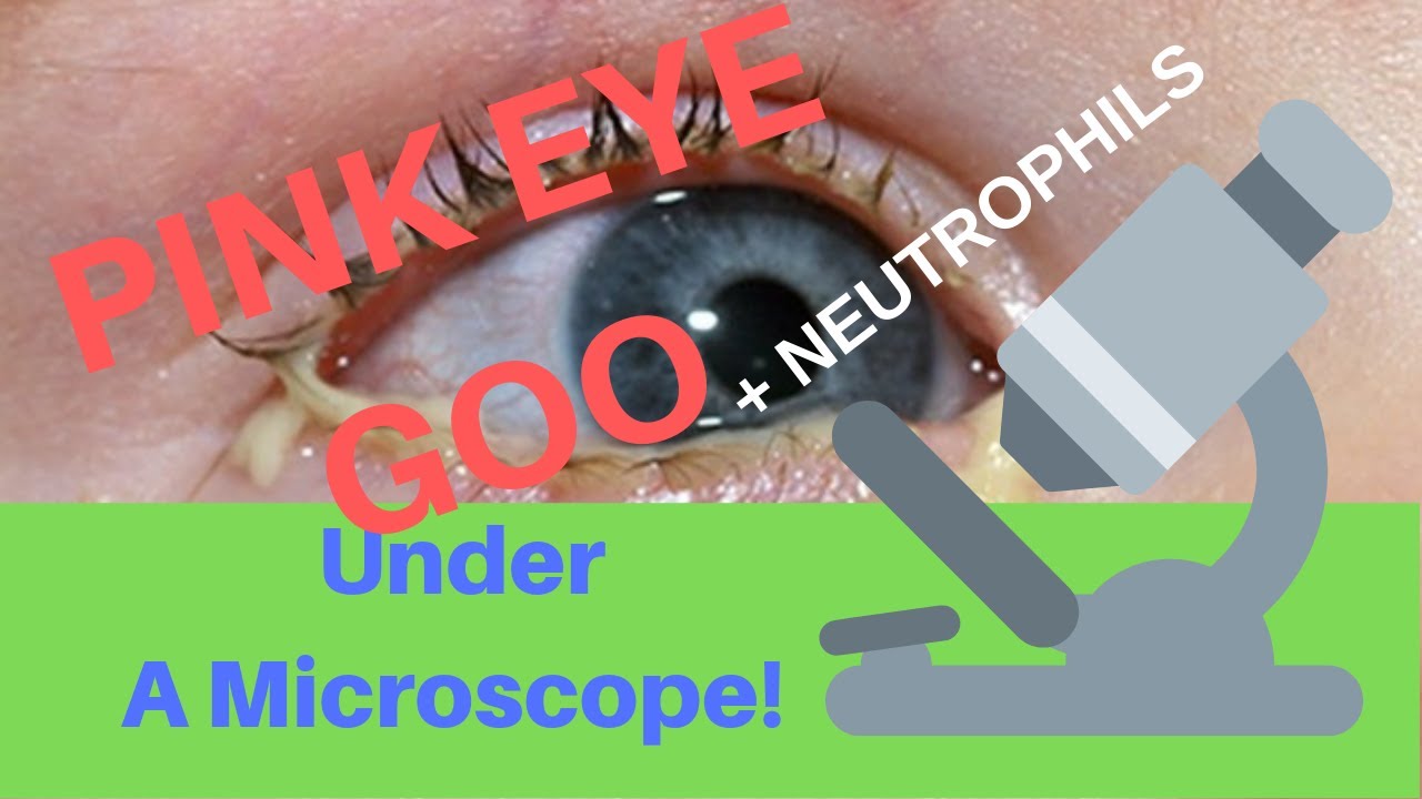 PINK EYE GOO Under A Microscope + Neutrophils!