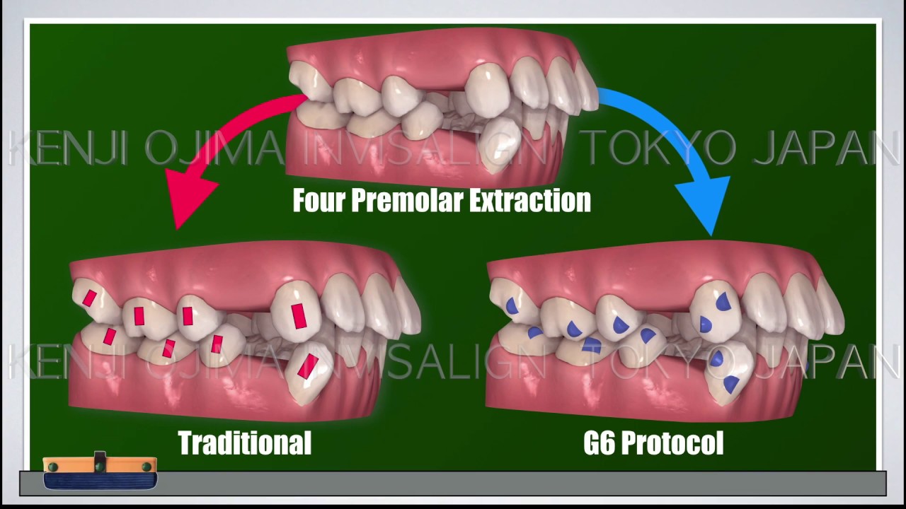 Invisalign Premolar Extraction G6 Protocol【インビザライン抜歯G6】How Different for G6 Protocol or Traditional
