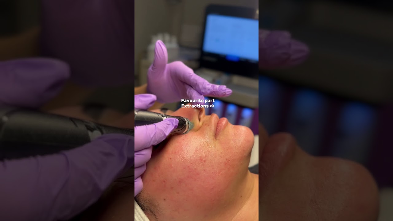 Hydrafacial in action 🫧 #hydrafacial #birmingham #nonsurgical #glowyskin #healtyskin