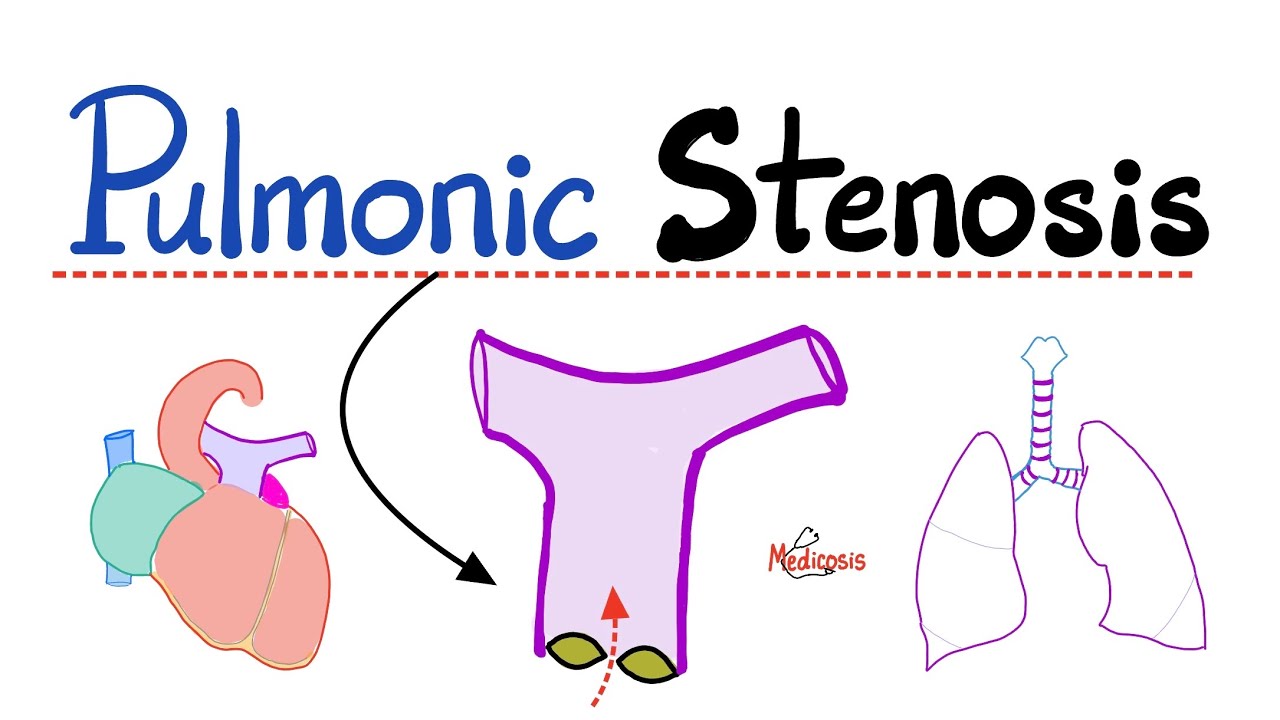 Pulmonic Stenosis (PS) - Pulmonic Valve Stenosis - Valvular Heart Disease (VHD) - Cardiology 🫀