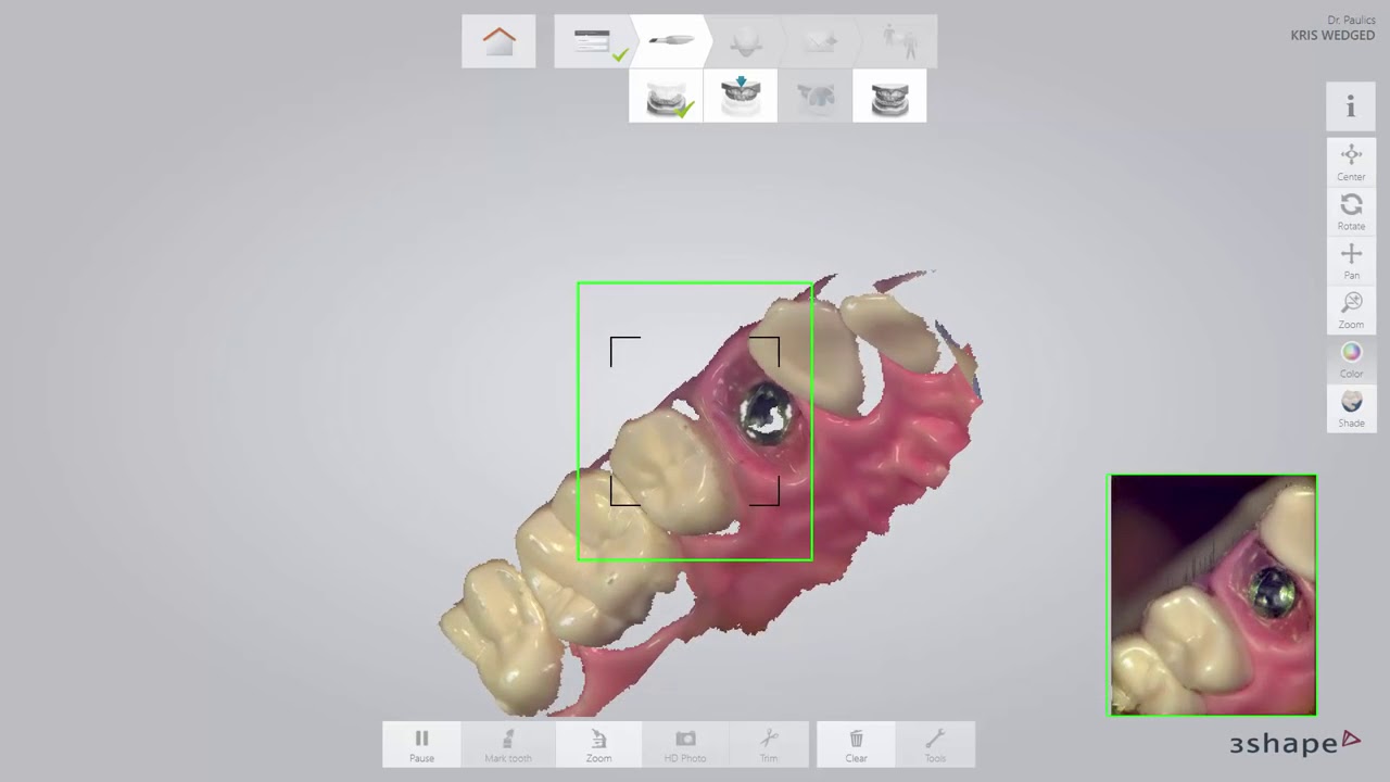 TRIOS庐   Implant restoration workflow