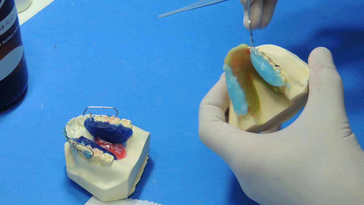 Bionator - Acrilização de união das placas