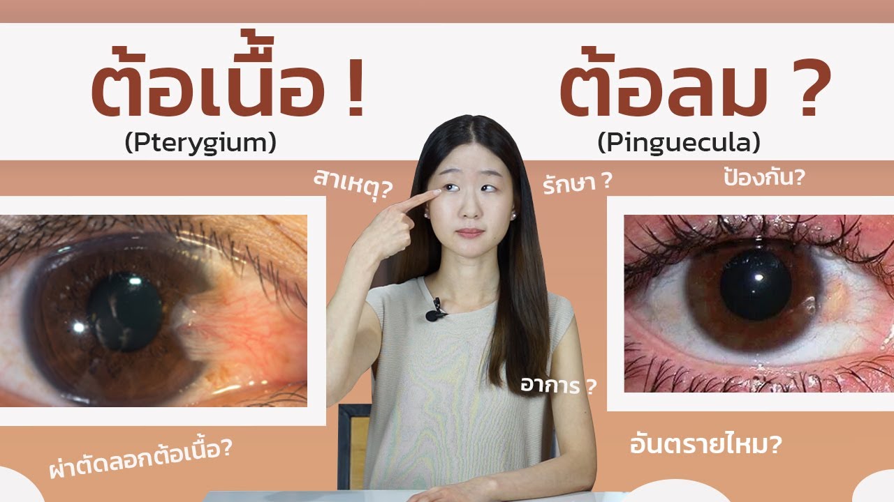 ต้อเนื้อ ต้อลม รักษายังไง ทำไมถึงเป็น ผ่าเลยดีไหม?(Pterygium vs Pinguecula) | Dr. Pat