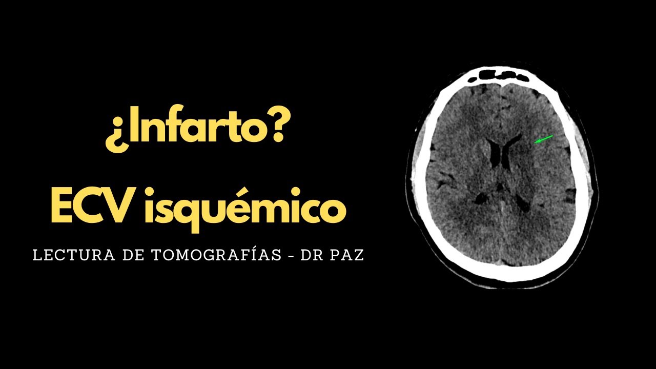 Lectura de Tomografías - Infarto cerebral? Ganglios basales