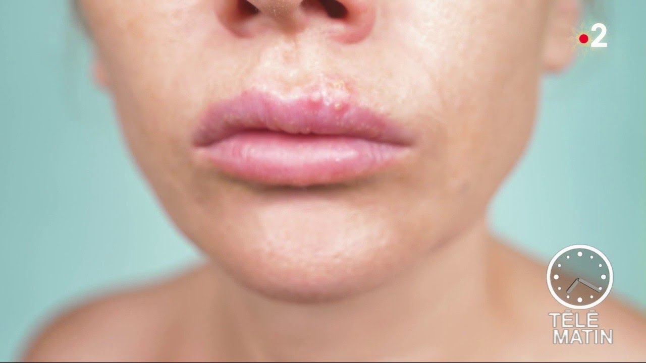 Santé - Herpès labial : éviter la contagion