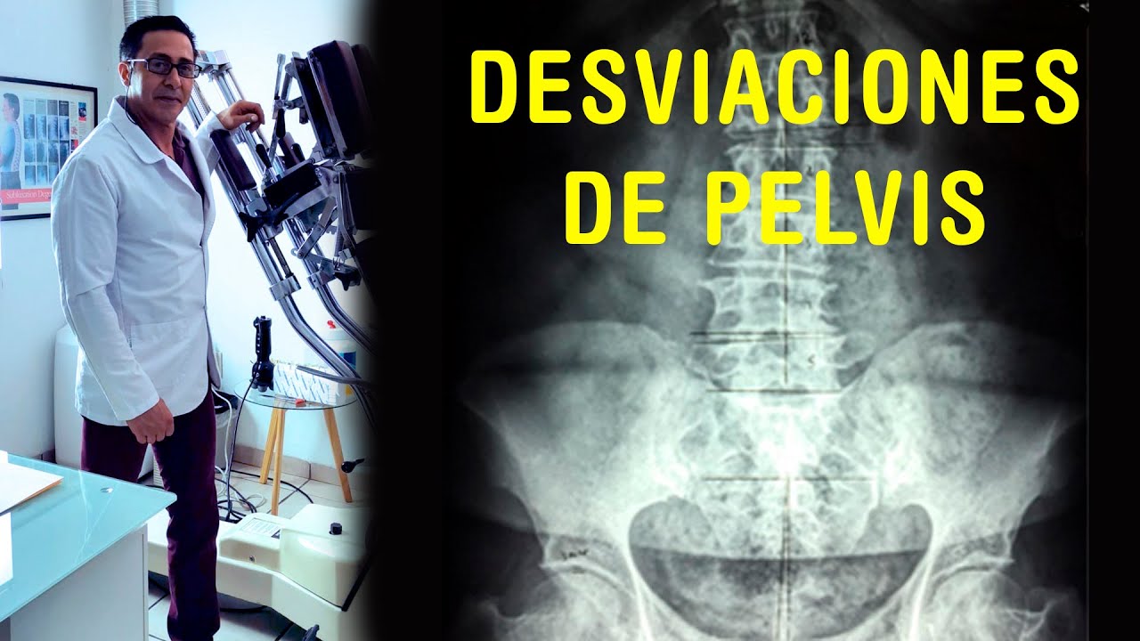 DESVIACIONES DE PELVIS
