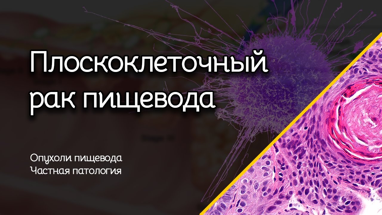 Плоскоклеточный рак пищевода | Опухоли пищевода | Частная патология