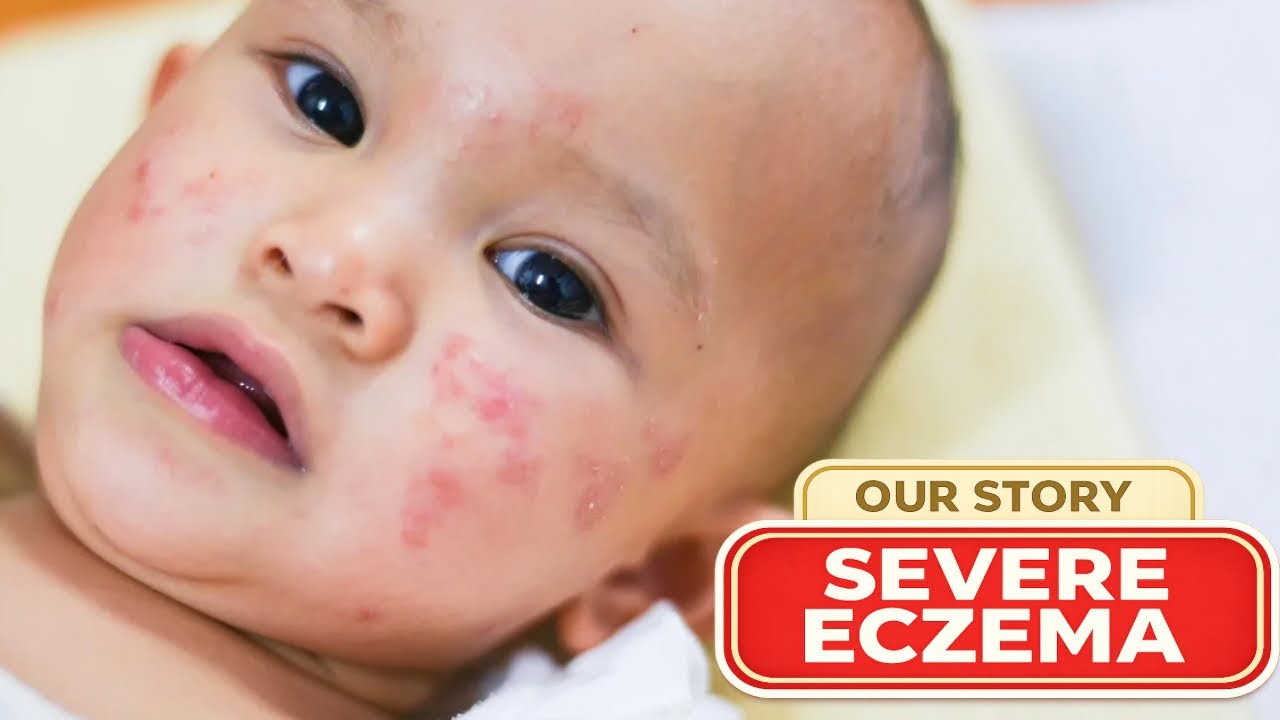 Severe Baby Eczema: What Happened