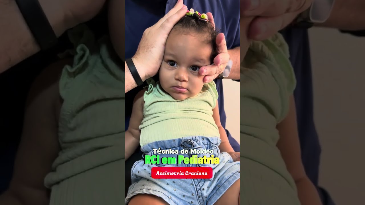 Tratamento de Plagiocefalia (Assimetria Craniana) no RCI em Pediatria