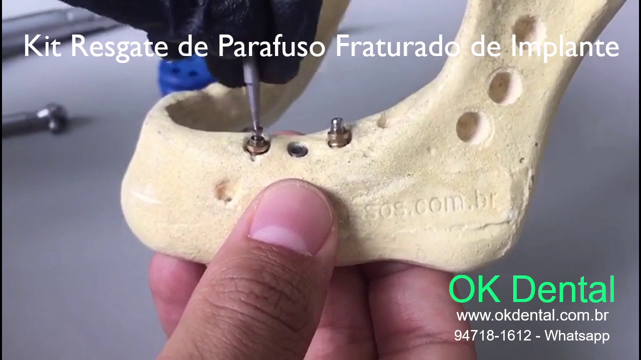 Kit Resgate de Parafuso Fraturado de Implante