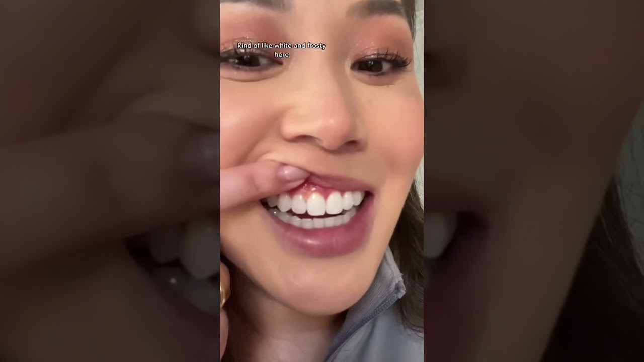 I accidentally burned my gums with teeth whitening chemicals. 