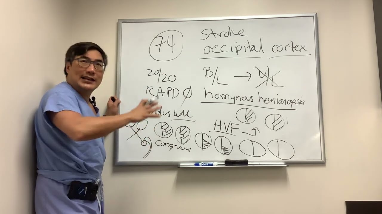 Occipital cortex stroke